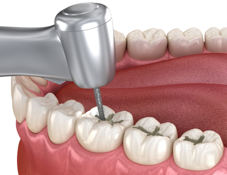 การอุดฟัน: วิธีรักษาฟันผุที่ช่วยคืนสุขภาพและความสวยงามให้ฟัน