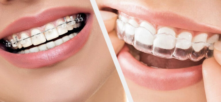 การจัดฟัน – แบบติดแน่น vs แบบใส